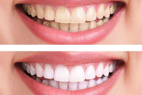 Tẩy trắng răng Laser Whitening