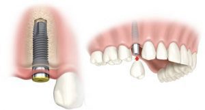 kỹ thuật trồng răng Implant được coi là giải pháp giúp khôi phục lại răng đã mất một cách toàn diện