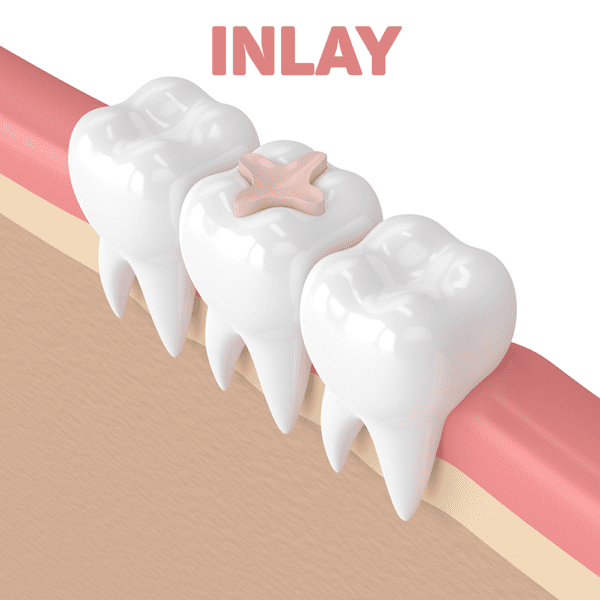 Phục hình răng Inlay