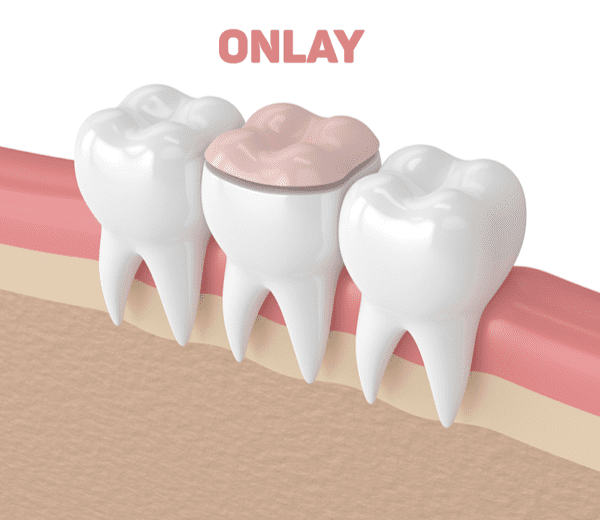 Phục hình răng Onlay
