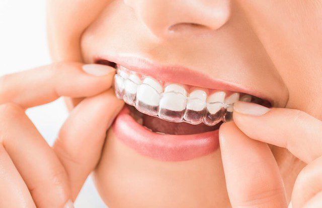 Niềng răng Invisalign trả góp tại Trung tâm Nha khoa Thẩm mỹ Hải Anh