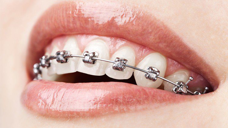 Mắc cài kim loại giúp tăng hiệu quả niềng răng như thế nào?