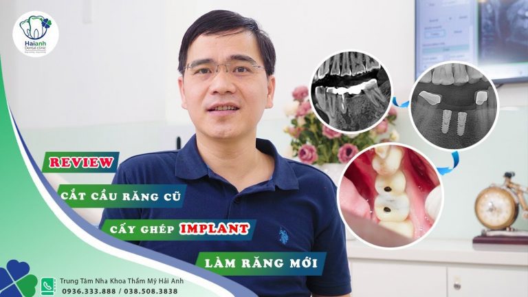 review-cat-cau-cay-ghep-implant-lam-rang-moi