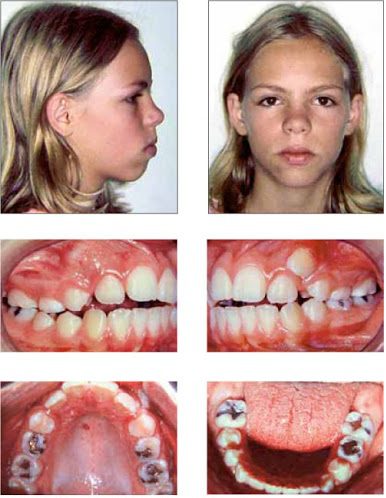 Răng sau khi niềng bị sâu nặng toàn hàm, vẫn hô